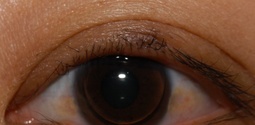眼瞼腫瘍・結膜腫瘍