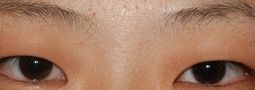 重瞼術による睫毛下垂の矯正