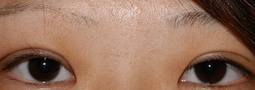 重瞼術による睫毛下垂の矯正