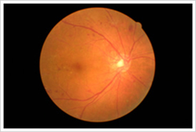 光凝固、硝子体手術で視力を維持できた増殖性糖尿病性網膜症の例
