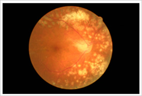 光凝固、硝子体手術で視力を維持できた増殖性糖尿病性網膜症の例